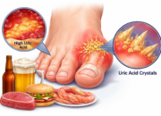 5 Makanan untuk Penderita Asam Urat yang Aman dan Menyehatkan