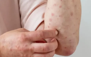 Kasus Campak di Jepang Naik Tajam, Meningkat Lebih dari Tiga Kali Lipat 3 IMG 20260310 143511