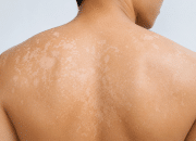 5 Tips Hilangkan Panu Pakai Bahan Alami yang Ampuh dan Mudah Dicoba