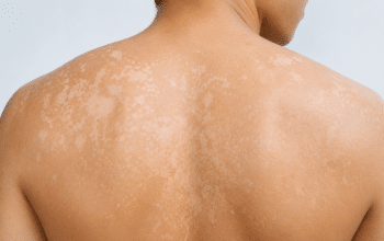 5 Tips Hilangkan Panu Pakai Bahan Alami yang Ampuh dan Mudah Dicoba