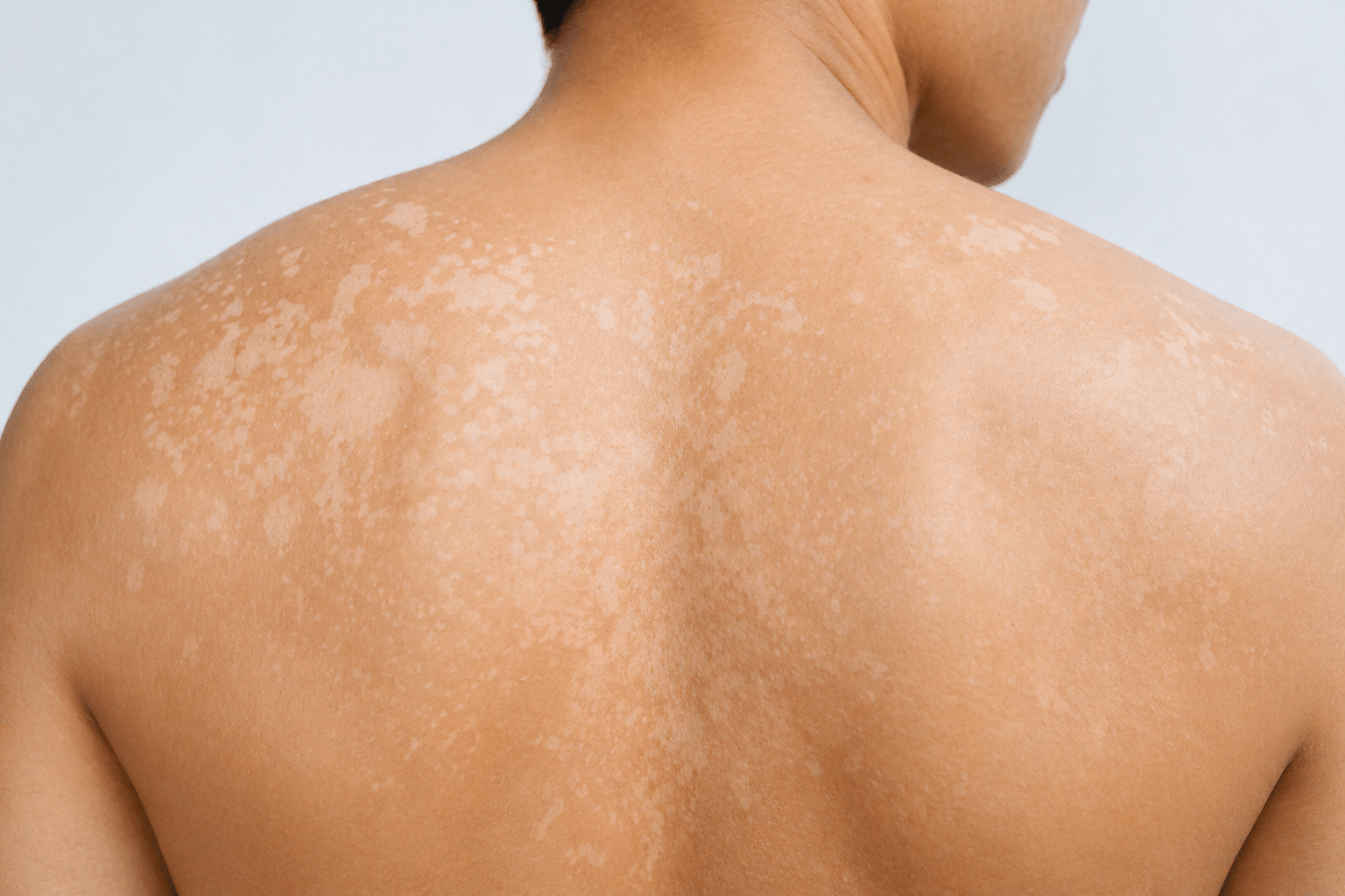 5 Tips Hilangkan Panu Pakai Bahan Alami yang Ampuh dan Mudah Dicoba