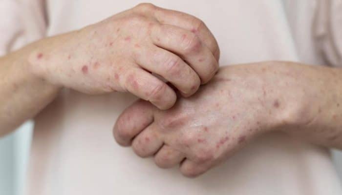 Suspek Campak Paling Banyak di Tangerang Selatan